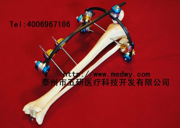 碳纖維組合式外固定架